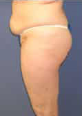 Tummy Tuck