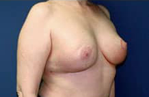 Breast Reconstruction with Tissue Expanders and Implants