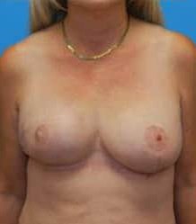 Breast Reconstruction with Tissue Expanders and Implants
