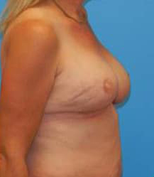 Breast Reconstruction with Tissue Expanders and Implants