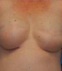 Breast Reconstruction with Tissue Expanders and Implants