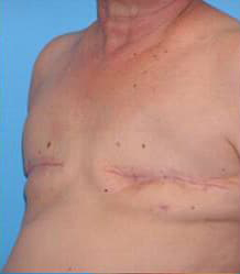 Breast Reconstruction with Tissue Expanders and Implants