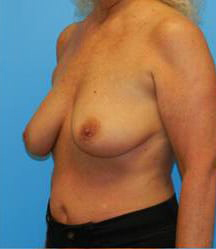 Breast Augmentation with Breast Lift