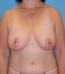 Breast Lift/Mastopexy