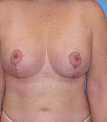 Breast Lift/Mastopexy