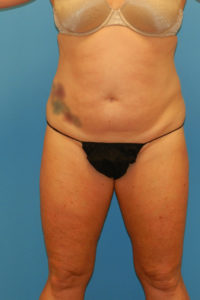 CoolSculpting