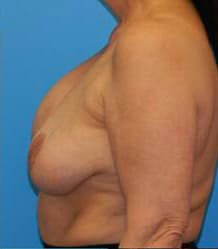 Breast Augmentation with Breast Lift