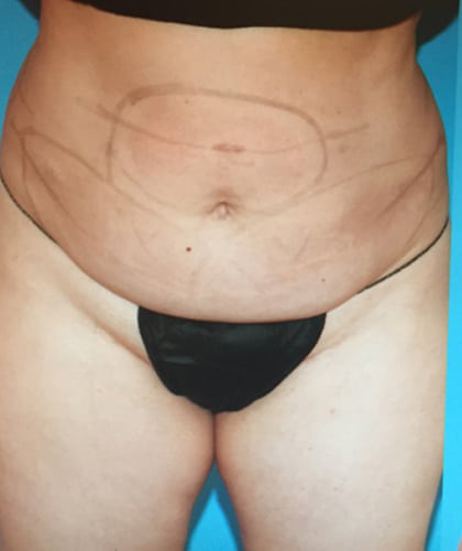 CoolSculpting