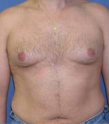 Gynecomastia