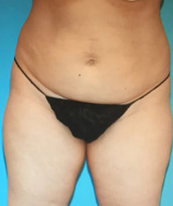 CoolSculpting