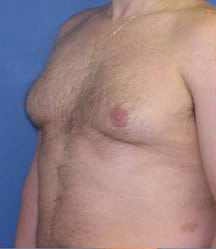 Gynecomastia