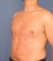 Gynecomastia