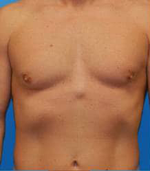 Gynecomastia