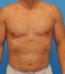 Gynecomastia