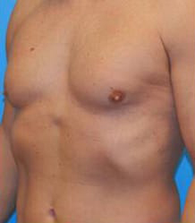 Gynecomastia