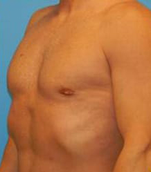 Gynecomastia