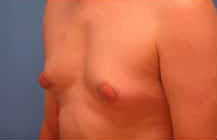 Gynecomastia