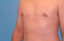 Gynecomastia