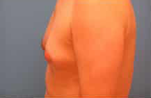 Gynecomastia