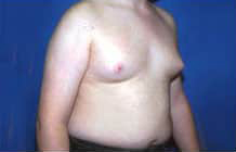 Gynecomastia