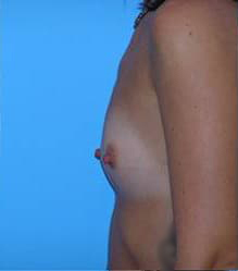 Breast Augmentation (Silicone)