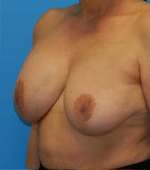 Revisional Breast Augmentation
