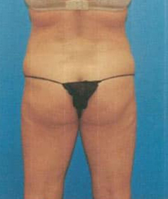 CoolSculpting