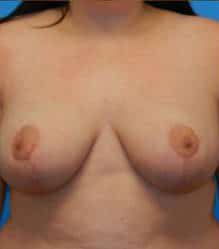 Breast Reduction