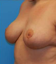 Breast Reduction