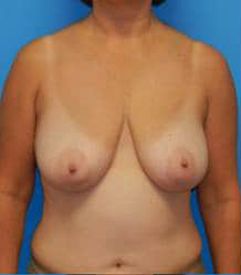 Breast Lift/Mastopexy