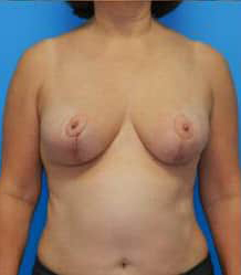 Breast Lift/Mastopexy