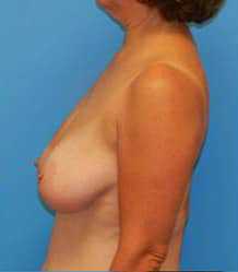 Breast Lift/Mastopexy