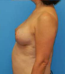 Breast Lift/Mastopexy