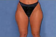 Liposuction