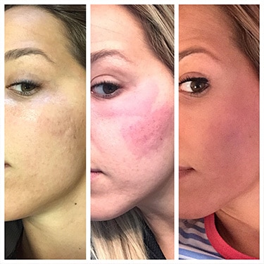 Laser Skin Resurfacing Before and After Photos