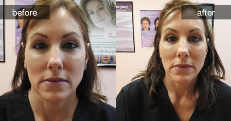 Botox Before and After Photos