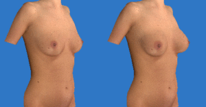 Breast augmentation simulation