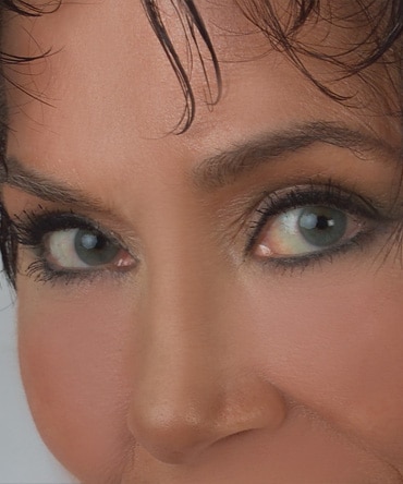 Brow Lift & Blepharoplasty