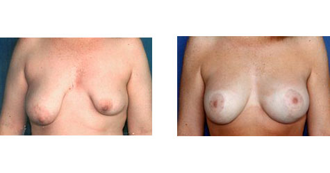 Asymmetrical Tuberous Breasts Before and After Photos