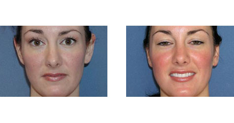 Otoplasty Before and After Photos