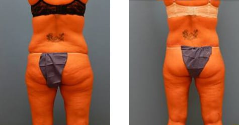 After Weight Loss Surgery Before and After Photos