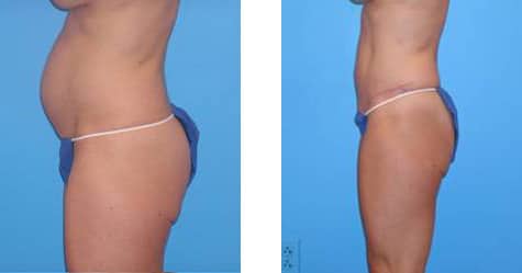 Tummy Tuck Results Pittsburgh