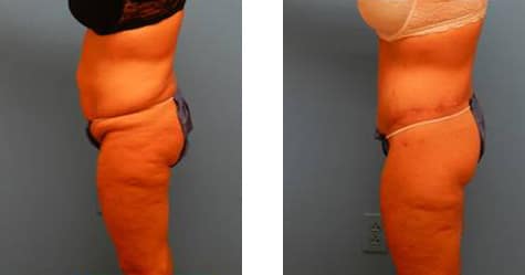 After Weight Loss Surgery Before and After Photos