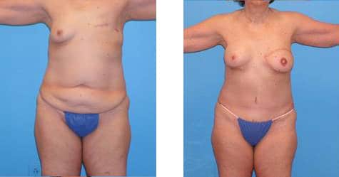 Breast  Reconstruction Before and After Photos