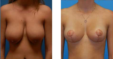 Breast  Reduction Before and After Photos