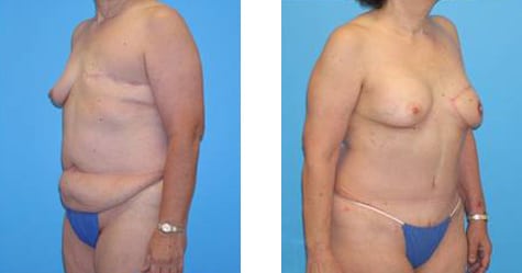 Breast  Reconstruction Before and After Photos