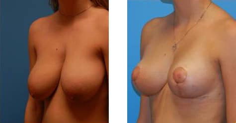 Breast  Reduction Before and After Photos