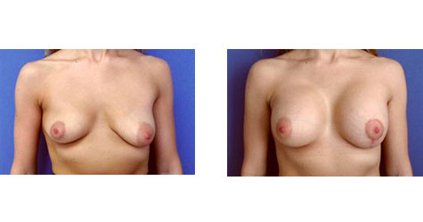 Asymmetrical Tuberous Breasts Before and After Photos