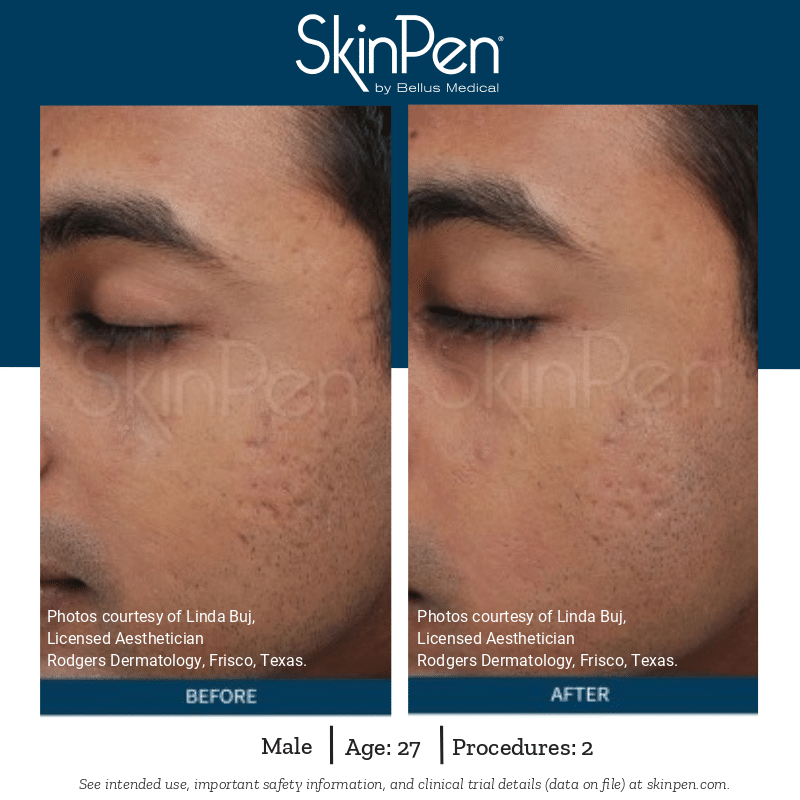 SkinPen Microneedling