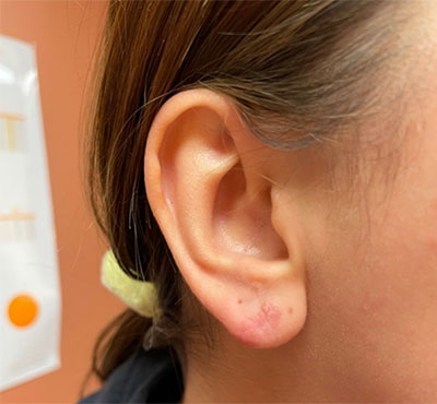 Otoplasty